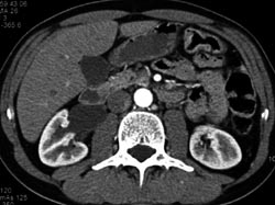 Hydronephrosis Due to A Ureteropelvic Junction (UPJ) Obstruction - CTisus CT Scan