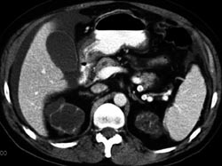 End Stage Renal Cystic Disease - CTisus CT Scan