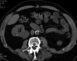 Renal Cell Carcinoma - CTisus CT Scan