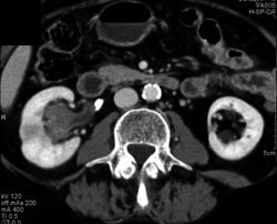 Transitional Cell Carcinoma - CTisus CT Scan