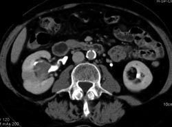 Transitional Cell Carcinoma - CTisus CT Scan