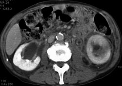 Inflamed Left Ureter With Pyelonephritis - CTisus CT Scan