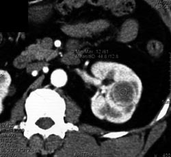 Renal Carcinoma - CTisus CT Scan