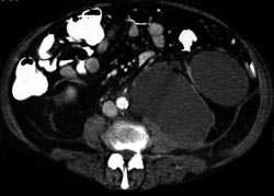 Pseudocyst Compresses the Kidney - CTisus CT Scan