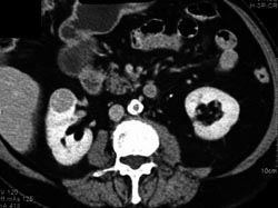 Renal Cell Carcinoma - CTisus CT Scan