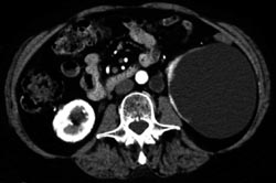 Tuberculosis (TB) of the Ureter - CTisus CT Scan