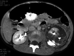 Renal Laceration With Extravasation on Delayed Scan - CTisus CT Scan