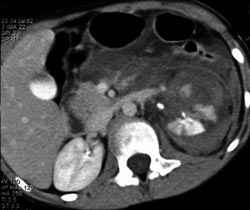 Renal Laceration - CTisus CT Scan