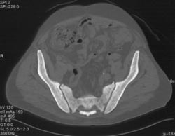 Extramedullary Hematopoiesis - CTisus CT Scan