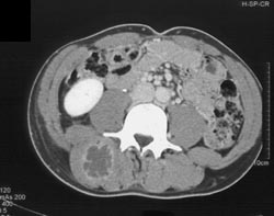 Paraspinal Abscess Presented as Renal Colic - CTisus CT Scan