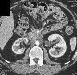 Retroperitoneal Fibrosis - CTisus CT Scan