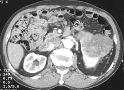 Renal Cell Carcinoma - CTisus CT Scan