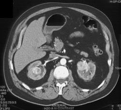 Vascular Metastases - CTisus CT Scan