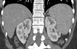 Prior Renal Infarct - CTisus CT Scan