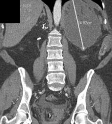 Hematoma S/P Nephrectomy - CTisus CT Scan