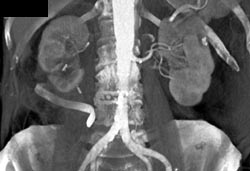 Post Cryosurgery Right Kidney - CTisus CT Scan