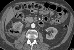 Post Cryo CT Appearance - CTisus CT Scan