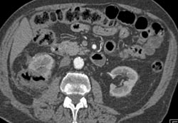 Contrast Extravasation on Delayed Scans - CTisus CT Scan