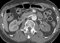 Renal Infarct Due to Dissection - CTisus CT Scan