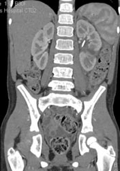 Renal Laceration - CTisus CT Scan