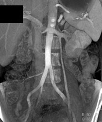 Left Gonadal and Adrenal Veins - CTisus CT Scan