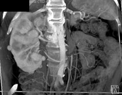 Multifocal Renal Carcinoma - CTisus CT Scan