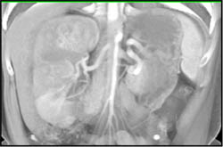 Renal Calculus Scan on Early Phase - CTisus CT Scan