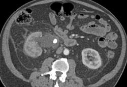 Stone Obstructing Right Renal Pelvis - CTisus CT Scan