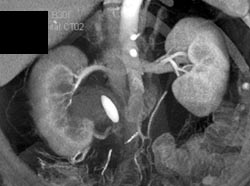 Obstructing Stone Right Renal Pelvis - CTisus CT Scan