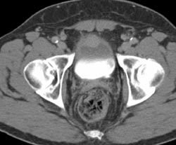 Bladder Cancer - CTisus CT Scan