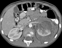 Renal Laceration - CTisus CT Scan