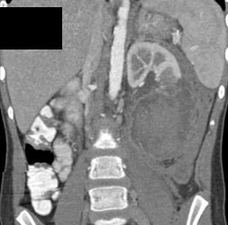 Renal Laceration With Extravasation on Late Phase Scans - CTisus CT Scan