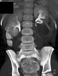 Contrast Extravasation Due to Renal Trauma - CTisus CT Scan