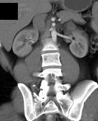 Normal Arterial Anatomy in 3D - CTisus CT Scan