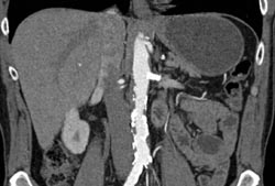 Patent Renal Artery Stent - CTisus CT Scan