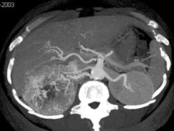 Vascular Renal Cell Carcinoma - CTisus CT Scan