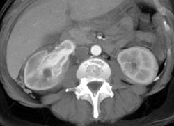 Hypervascular Renal Cell Carcinoma - CTisus CT Scan