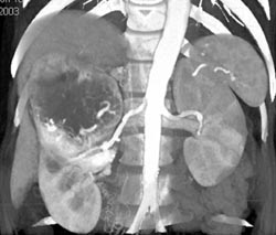 Neovascularity in Renal Cell Carcinoma - CTisus CT Scan