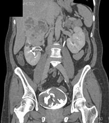 Blood Clots in Renal Pelvis and Bladder - CTisus CT Scan