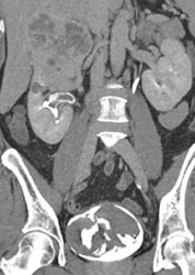 Filling Defects Due to Blood Clots - CTisus CT Scan