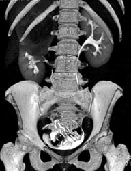 3D of Blood Clot - CTisus CT Scan