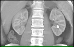 Renal Cell Carcinoma - CTisus CT Scan