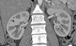 1 Cm Angiomyolipoma (AML) - CTisus CT Scan