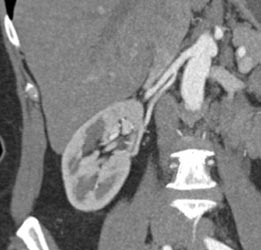 Prehilar Branching of Renal Artery - CTisus CT Scan