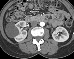 Renal Cyst - CTisus CT Scan