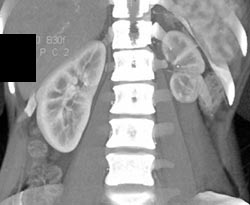 Scarred Left Kidney - CTisus CT Scan