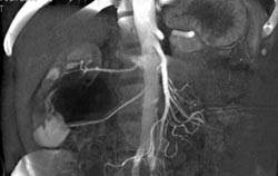 Ureteropelvic Junction (UPJ) Due to Accessory Lower Pole Artery - CTisus CT Scan