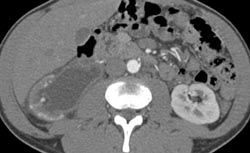 Ureteropelvic Junction (UPJ) - CTisus CT Scan