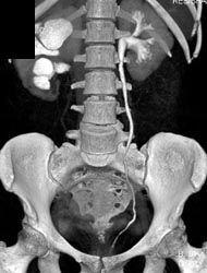 Ureteropelvic Junction (UPJ) With Delayed CT Urogram - CTisus CT Scan