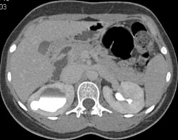 Hydronephrosis Due to Ureteropelvic Junction (UPJ) - CTisus CT Scan